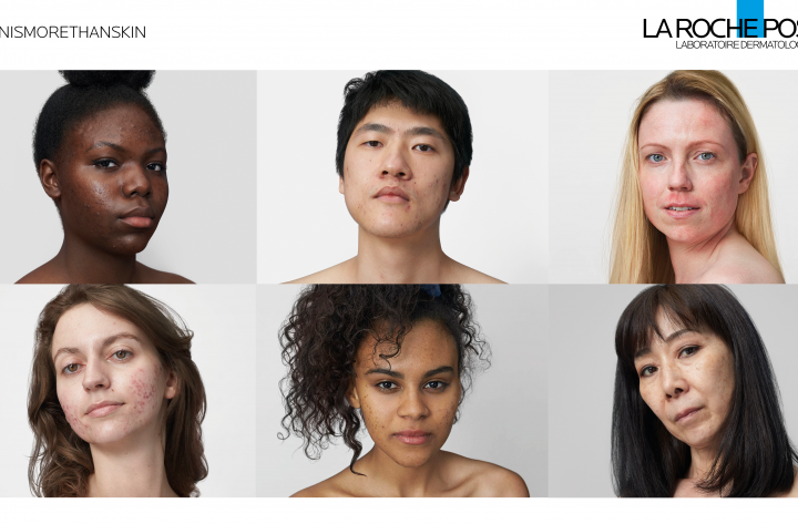 LES PROBLÈMES DE PEAU SONT PLUS SÉRIEUX QUE VOUS NE LE PENSEZ,  DÉCLARE LA ROCHE-POSAY DANS SA TOUTE PREMIÈRE CAMPAGNE DE MARQUE.